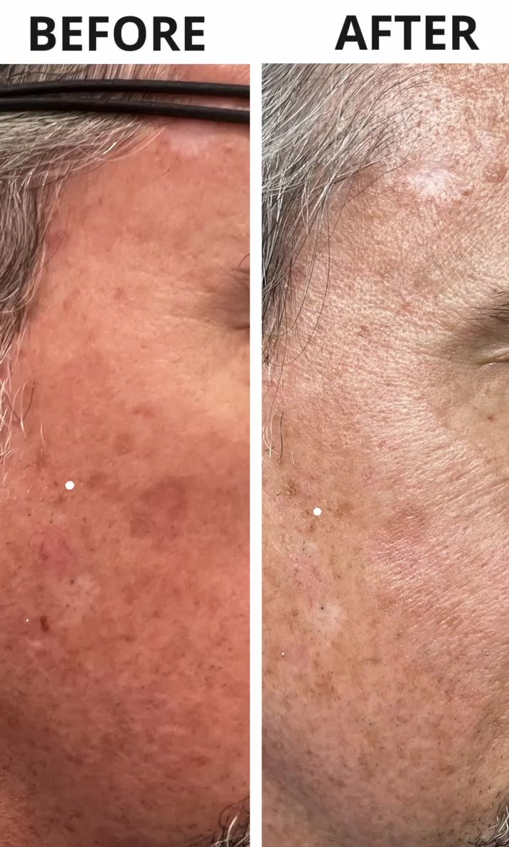 Spider Vein / Spot Removal – midohioaesthetics