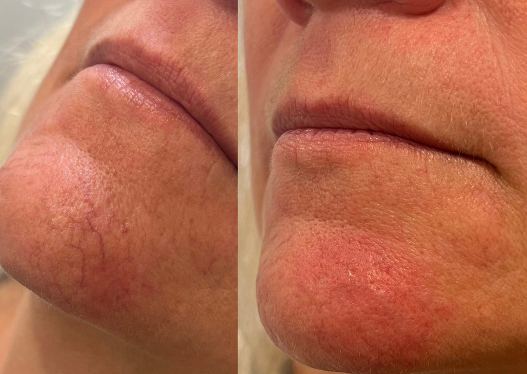Spider Vein / Spot Removal – midohioaesthetics